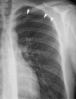 Neumotórax parcial en el pulmón izquierdo.