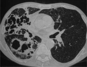 Tomografía computarizada de tórax que muestra un patrón alveolar con cavitaciones que afectan a los 3 lóbulos del pulmón derecho y a la língula.