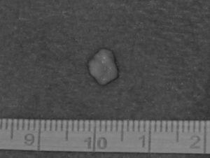 Broncolito de aspecto coraliforme, blanco amarillento, de 5–7mm de diámetro, que expectoró la paciente.
