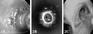 Procedimiento de la ultrasonografía endobronquial radial. A: minisonda ecográfica y catéter balón. B: imagen ecográfica, donde se visualizan el bronquio principal derecho (RMB), la adenopatía (LN), el tumor (TU) y la arteria pulmonar derecha (RPA). C: punción aspirativa transbronquial (PATb).