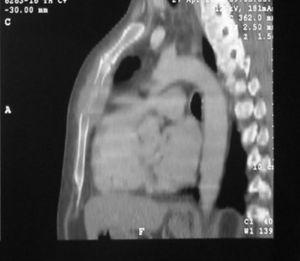 Computatietomografie toonde een lytische massa aan de linkerkant van het sternum. Er was geen duidelijke mediastinale invasie.