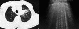 Tomografía computarizada de tórax (izqda.): neoplasia pulmonar en el lóbulo superior izquierdo, con engrosamiento de septos interlobulillares, indicativo de linfangitis carcinomatosa. Ecografía torácica (dcha.): múltiples artefactos de cola de cometa que traducen el engrosamiento de los septos interlobulillares.