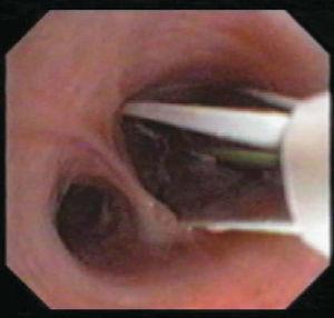 Imagen broncoscópica del catéter de termoplastia con los electrodos separados en contacto con la pared bronquial. (Cortesía de Asthmatx Inc.)