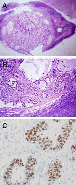 A. Imagen macromicroscópica del nódulo del ovario. B. Imagen microscópica del tumor ovárico con clara diferenciación tubular-glandular y bien delimitado con respecto al parénquima del ovario adyacente. C. Tinción inmunohistoquímica nuclear positiva para TTF-1, asociada a un perfil de queratinas 7 positiva, 20 negativa y cromogranina negativa.