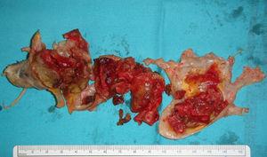 Pieza quirúrgica de enfermedad pulmonar tromboembólica crónica tipo 1.