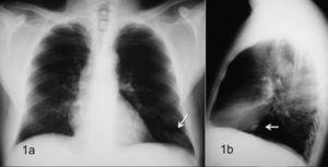 Radiografías posteroanterior (a) y lateral (b) de tórax, donde se observa una nodulación (flechas blancas) en el lóbulo inferior izquierdo.
