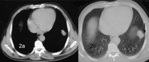 Tomografía computarizada sin contraste intravenoso, que evidencia una nodulación sólida y homogénea con ventana de mediastino (a), con bordes espiculados y signo de la “cola pleural” (flecha negra) con ventana de parénquima (b).