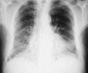 Radiografía de tórax de un paciente diagnosticado de combinación de fibrosis pulmonar y enfisema. Se observa afectación patrón intersticial bilateral, de predominio derecho con infiltrados reticulonodulares de distribución basal y subpleural y disminución de la densidad pulmonar en campos superiores, principalmente izquierdo.