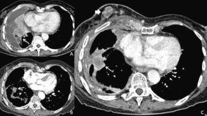 Tomografía axial de tórax. A) Basal al diagnóstico, en la que se observan metástasis pulmonares múltiples y derrame pleural. B) Tras 15 meses de tratamiento con erlotinib, con marcada disminución tanto del derrame pleural como de las lesiones parenquimatosas pulmonares; y C) a la progresión a los 20 meses del inicio de erlotinib, con aumento de la afectación pulmonar y aparición de nódulo mamario (flechas).