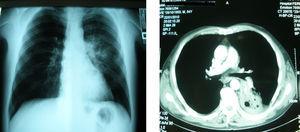 Radiografía de tórax y tomografía computarizada de tórax en las que se aprecia la presencia de una consolidación con cavitaciones en su interior, localizada en el lóbulo inferior izquierdo.