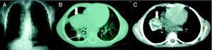 A) Rx anteroposterior de tórax: muestra una consolidación pulmonar en lóbulo medio con ensanchamiento paratraqueal derecho y una lesión enfisematosa en el hemitórax derecho. B-C) TACAR pulmonar: muestra adenopatías mediastínicas derechas (C) y una colección loculada bien delimitada de aspecto necrótico parcialmente calcificada (flechas gruesas), de gran tamaño (3,5 x 4cm), e imágenes adyacentes de consolidación pulmonar con componente atelectásico en lóbulo inferior derecho y lóbulo medio (flecha fina).