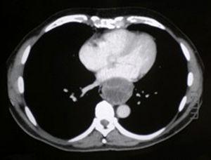 Corte axial de tomografía computarizada que muestra una masa mediastínica posterior que comprime la luz esofágica y la aurícula izquierda.