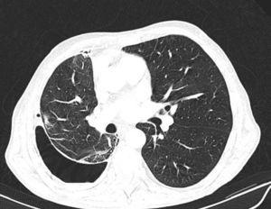 La tomografía computarizada de tórax con contraste de aire demuestra un engrosamiento anormal de la pleura visceral que impide la expansión normal del pulmón.
