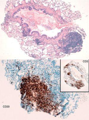 Bronquiolo terminal rodeado de agregados linfoides y folículos linfoides. Tinción de inmunohistoquímica CD 20 con folículos de células B linfoides y CD3 con agregados de células T.