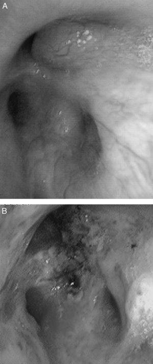 Infiltración de la submucosa (A) y lesiones nodulares (B) en la broncoscopia.