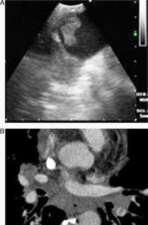A-B) Embolia bilateral en la arteria pulmonar central en la TC de tórax.
