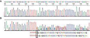 Secuencia correspondiente al exón 5 del gen SERPINA1. A)Secuencia normal. B)Secuencia correspondiente a la paciente, donde se ve la inserción de una timina (T) en vez de una adenina (A) en el codón 376 del exón 5 en heterocigosis, correspondiente al alelo PI-Mattawa. La secuencia codificante del gen SERPINA1 (exones 2 a 5) se analizó utilizando primers previamente descritos para los exones 3 a 5 y primers ex2F 5′ACGTGGTGTCAATCCCTGATCACTG3′ y ex2R 5′TATGGGAACAGCTGG3′ para el exón 2, tomando como referencia comparativa la SERPINA1_Transcript_ENST00000440909.