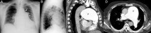Rx tórax PA (A) y lateral (B) en la que se visualiza lesión redondeada de perfiles lisos localizada a nivel del hilio izquierdo en la proyección PA (flechas 1A), que se proyecta al espacio retroesternal (flecha 1B). La TC torácica con la administración de CIV, proyección sagital y axial (C-D) confirma la dilatación aneurismática del cono de la arteria pulmonar.