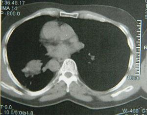 La tomografía computarizada de tórax del paciente revela una atelectasia segmentaria que se extiende desde el lóbulo inferior derecho hasta el lóbulo medio derecho.