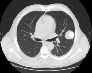 Masa pulmonar en LSI de 4,9×4,1cm.