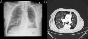 A)Radiografía de tórax tras la colocación de drenaje torácico. B)Detalle de la TC de tórax.