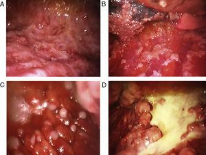 Various thoracoscopic aspects of malignant pleural mesothelioma. A. Massive infiltration of the parietal pleura by malignant epithelioid-type mesothelioma. B. Diffuse infiltration of the parietal and visceral pleura by malignant epithelioid-type mesothelioma. C. "Pearl" nodules in massive involvement of the parietal pleura due to epithelioid-type mesothelioma. D. Pleural plaques and masses of sarcomatous mesothelioma in the parietal pleura. Various thoracoscopic aspects of malignant pleural mesothelioma. A. Massive infiltration of the parietal pleura by malignant epithelioid-type mesothelioma. B. Diffuse infiltration of the parietal and visceral pleura by malignant epithelioid-type mesothelioma. C. "Pearl" nodules in massive involvement of the parietal pleura due to epithelioid-type mesothelioma. D. Pleural plaques and masses of sarcomatous mesothelioma in the parietal pleura.