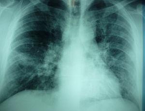 Radiografía de tórax del paciente al ingreso que muestra infiltrados alveolares difusos y extendidos por todo el pulmón izquierdo y campo medio del pulmón derecho.