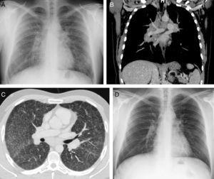 Radiografía de tórax (A) en la que se observa un ensanchamiento mediastínico, un aumento del tamaño de los hilios pulmonares y un patrón intersticial. La TC de tórax confirma la presencia de adenopatías mediastínicas de tamaño significativo, una afectación hiliar bilateral (B, reconstrucción coronal con contraste intravenoso) y del parénquima pulmonar (C, imagen axial en ventana de pulmón). Radiografía de tórax (D) obtenida 6 meses después del comienzo del tratamiento con corticoides que muestra una normalización de los hallazgos.