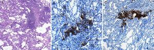 Imagen de microscopia óptica sobre corte histológico de biopsia pulmonar realizada mediante criobiopsia, donde se observa: A)el buen grado de conservación de las estructuras alveolares de la muestra, así como la presencia de infiltrado inflamatorio de predominio linfocitario localizado en el intersticio (hematoxilina-eosina, 40×). B)El estudio inmunohistoquímico muestra la presencia de linfocitosT (marcaje de CD3; 100×) y C)de linfocitosB (marcaje de CD20, 100×). El paciente fue diagnosticado de neumonía intersticial linfocitaria, sin evidencia de linfoma.