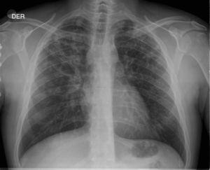 Radiografía de tórax del caso 1. Infiltrado bilateral trescavitado en lóbulo superior derecho.