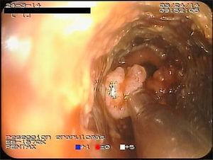 Punta del microdebridador resecando un granuloma en el extremo distal de la prótesis metálica.