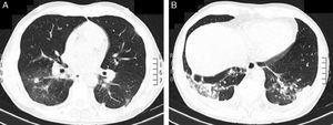 La tomografía computarizada de tórax mostró: A) Lesiones nodulares bilaterales y densidad en vidrio deslustrado, afectando mayormente a los lóbulos inferiores. B) Área de condensación parenquimatosa y derrame pleural asociado en LII.
