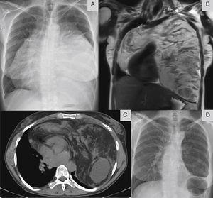 A) Radiografía de tórax (proyección posteroanterior) en la que se observa una opacidad de gran tamaño, y el signo de la silueta cardíaca. B y C) RM y TC torácicas que muestran una masa muy heterogénea, que rodea al corazón por ambos lados. D) Radiografía de tórax (proyección posteroanterior) efectuada después de la resección quirúrgica, en la que se observa la expansión de ambos pulmones.