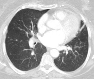 Múltiples nódulos pulmonares bilaterales.