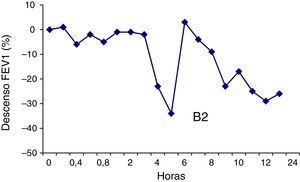 Resultado de la prueba de provocación bronquial específica a cinc. Se observa una caída tardía del FEV1 del 23% respecto al valor basal tras la inhalación de sulfato de cinc a una concentración de 0,1mg/ml durante 5min, que obligó a la administración de ß2-agonista (B2).