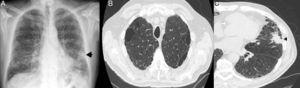 Paciente con CFPE y CP. A) Radiografía de tórax (proyección postero-anterior): Se observa una opacidad pulmonar focal nodular mal definida (flecha) en la base del pulmón izquierdo, así como una afectación intersticial reticular en ambas bases pulmonares. B) TCAR torácica que muestra la presencia de enfisema en los lóbulos superiores. C) La TCAR torácica confirma la presencia de una masa pulmonar de bordes lobulados y espiculados (cabeza de flecha) en la língula, adyacente a un área de panalización. CFPE: combinación de fibrosis pulmonar y enfisema; CP: cáncer de pulmón; TCAR: tomografía axial computarizada de alta resolución.