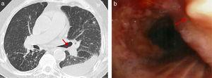 La tomografía axial computarizada (TAC) torácica (a) y la fibrobroncoscopia (b) muestran nódulos osteocartilaginosos en la pared anterior de la tráquea. En la TAC torácica también pueden observarse nódulos centrolobulillares y derrame pleural izquierdo (a).