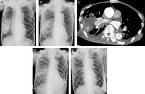 Imágenes radiológicas del día del ingreso (A) y de 4 días más tarde (B). Imagen de la TAC con contraste (C). Imágenes radiológicas de 3 días (D) y un mes (E) después de la embolización de la arteria pulmonar.