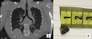 A) Corte sagital de la tomografía torácica que muestra cuerpo extraño radio-opaco en la carina. B) Piedra de 1cm de diámetro mayor que fue extraída mediante fibrobroncoscopia.
