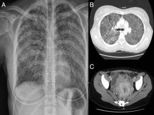 A) Radiografía simple de tórax. B) Corte axial de la TAC de tórax. C) Corte axial de la TAC de pelvis.