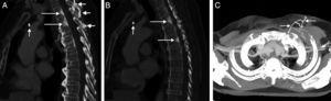 A) Reconstrucción sagital de la TC de tórax con contraste intravenoso en la que se observan lesiones focales óseas esclerosas en el margen posterior de los cuerpos vertebrales de T2 y T3 (flechas largas) que simulan metástasis vertebrales. Nótese el catéter del reservorio en el lugar teórico de la vena innominada trombosada (flecha corta vertical) y el desarrollo de circulación colateral venosa en venas perivertebrales (flechas cortas horizontales). B) Reconstrucción sagital de la TC de tórax con contraste intravenoso en la que se observan lesiones focales óseas esclerosas en el margen posterior de los cuerpos vertebrales de T3 y T5 (flechas largas). Nótese el catéter del reservorio en el lugar teórico de la vena innominada trombosada (flecha corta). C) Reconstrucción de proyección de máxima intensidad axial de la TC en la que se aprecia desarrollo de circulación colateral venosa en la pared torácica anterior (flechas).