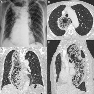 A chest radiograph (A) shows mediastinal widening with an air-fluid level, compatible with megaesophagus. Axial (B), coronal (C), and sagittal (D) reformatted CT images reveal marked esophageal dilatation with residue and multiple air bubbles.