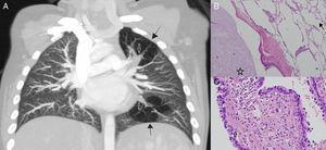 (A) Contrast-enhanced, coronal plane, chest computed tomography. Closed arrows show mucoceles and black arrows show air-trapped segments. (B) Haematoxylin–eosin, ×100 magnification. The air trapping areas (open arrow) and mucocele (asterix), confirming bronchial atresia. (C) Haematoxylin–eosin, ×400 magnification. CPAM areas (closed arrow) showed by respiratory epithelial lined cysts and a thin fibromuscular layer in the cyst wall.