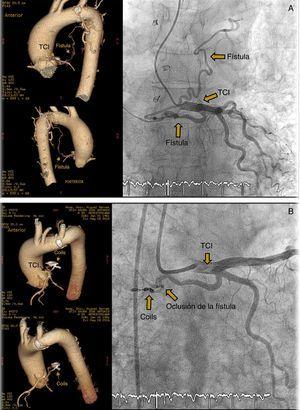 A) Fístula de arteria coronaria TCI a la arteria pulmonar izquierda. TC y angiografía. B) Oclusión percutánea con coils de fístula de arteria coronaria. TC y angiografía.