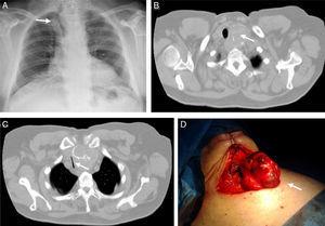 (A) Chest radiograph revealing an enlargement of the superior mediastinum with right deviation of the trachea, (B) Chest computed tomography scan showing a multinodular diving goitre, with compression and critical narrowing of the trachea (C). (D) Total thyroidectomy – resected goitre.