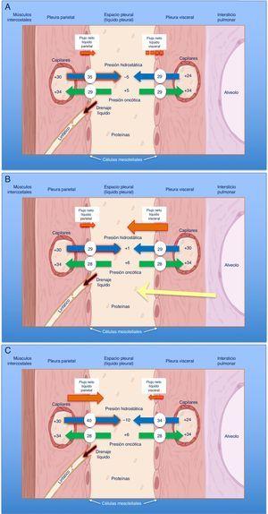 Esquemas de movimiento del líquido en el espacio pleural en condiciones normales (A), en la insuficiencia cardiaca (B) y en el pulmón atrapado (C). En un pulmón y pleura normales (A), el balance de presiones hidrostáticas y oncóticas favorece la formación de líquido pleural. Los gradientes de presiones muestran que existe un flujo neto de líquido desde la pleura parietal y que se mantiene en equilibrio en la pleura visceral (presiones en cm de H2O). En la insuficiencia cardiaca (B), se produce un aumento del líquido en el intersticio pulmonar debido al aumento de las presiones capilares pulmonares. El líquido que entra en el espacio pleural excede la capacidad de los linfáticos pleurales para drenarlo. En el pulmón atrapado (C), un proceso inflamatorio previo ha dado lugar a una pleura visceral gruesa y fibrosa. La incapacidad pulmonar para expandirse conduce a una presión pleural hidrostática negativa y esta alteración de las fuerzas de Starling lleva a la formación de un líquido pleural trasudativo. El derrame pleural puede estar al límite del exudado, dependiendo de cuán reciente sea la inflamación activa previa.