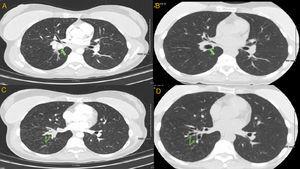 Chest CT. Panels A, C are cuts from pre-procedure scan. Panels B, D are the same cuts from post procedure scan. Calcified right hilar lesion (arrow, panel A). Collapsed RLL segmental bronchi (arrows, panel C). Post procedure, patent RLL bronchus (arrow, panel B). Post procedure, patent RLL segmental bronchi (arrows, panel D).