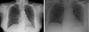 Imagen de la izquierda: neumotórax en hemitórax derecho. Imagen de la derecha: resolución del neumotórax tras el drenaje crónico.