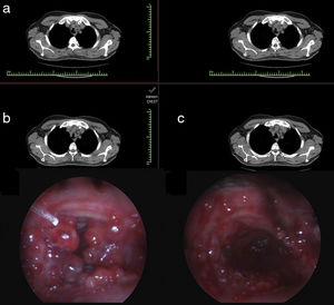 Tracheal lesions on the thorax computered tomography of the patient (a) Endobronchial view before (b) and after treatment (c).
