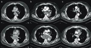 Sections of an axial chest CT of the mediastinal presenting the tumor in the posterior mediastinum. (a) Tumor of the posterior mediastinum before EBUS measuring 74×71×53m. (b) Tumor of 5.4cm (short axis) 14 days after EBUS with puncture. (c) Mediastinal axis 3 months following resection of the tumor.
